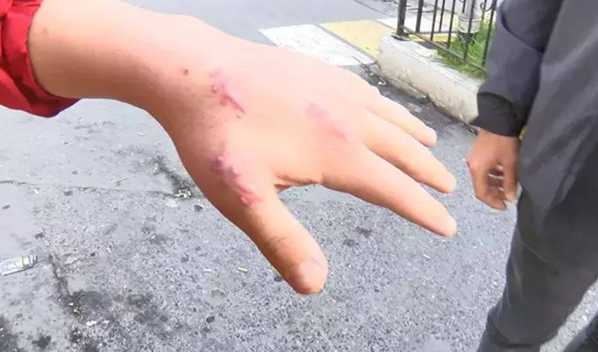 Dünyada bir ilk: Kedisi tarafından ısırılan vatandaşın 13 gün sonra baş parmağı düştü 1