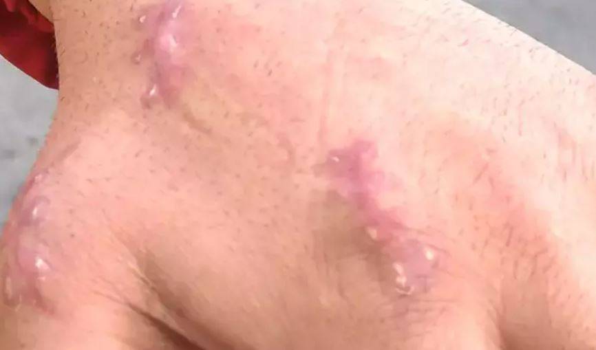 Dünyada bir ilk: Kedisi tarafından ısırılan vatandaşın 13 gün sonra baş parmağı düştü 2