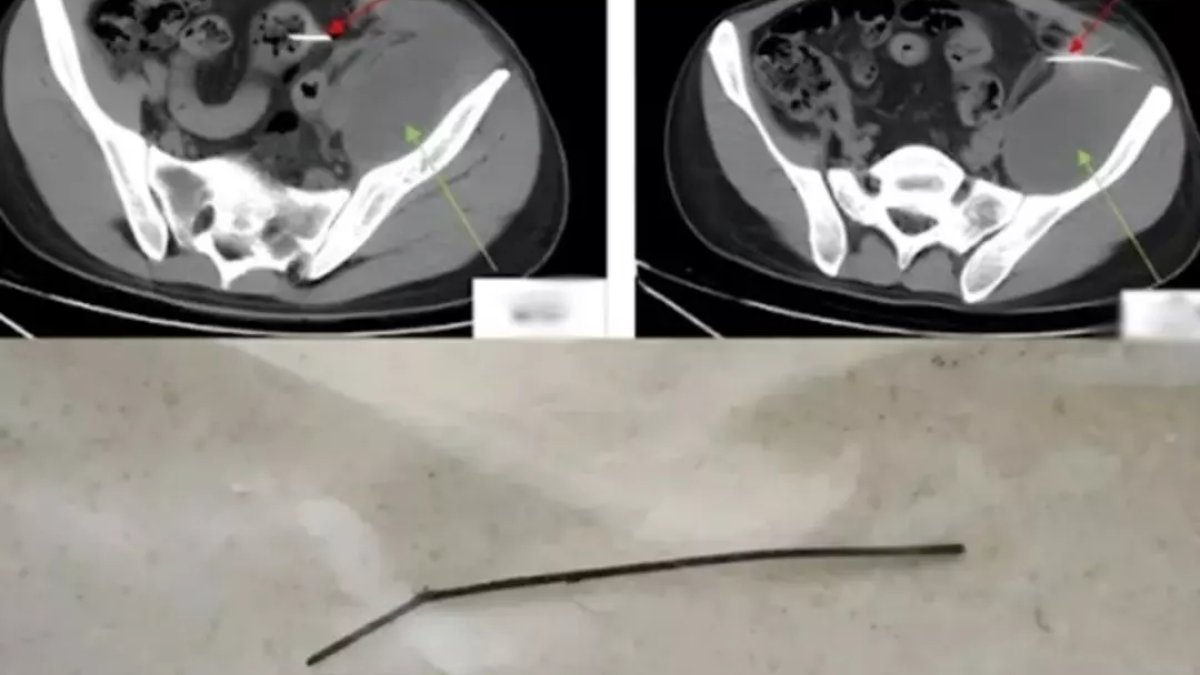 Doktorlar gördükleri karşısında şoke oldu: Günlerdir tuvalete çıkamıyordu