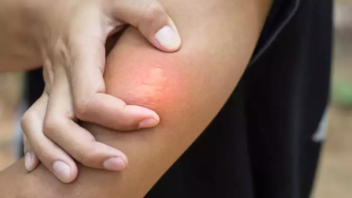 Sinek ısırığı kaşıntısını anında kesiyor! Kabuklarını çöpe atmayın: Doğal kaşıntı önleyici