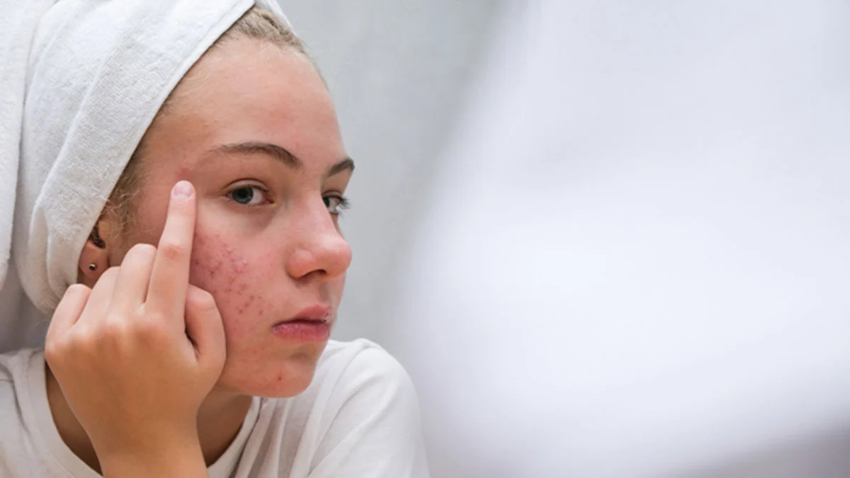 Akne için mRNA aşısı geliştirildi: Klinik deneyler devam ediyor