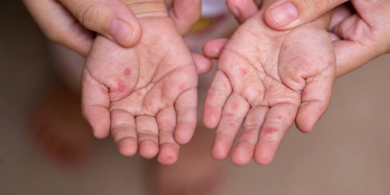 ABD’de kızamık alarmı: 33 yılın en yüksek seviyesi