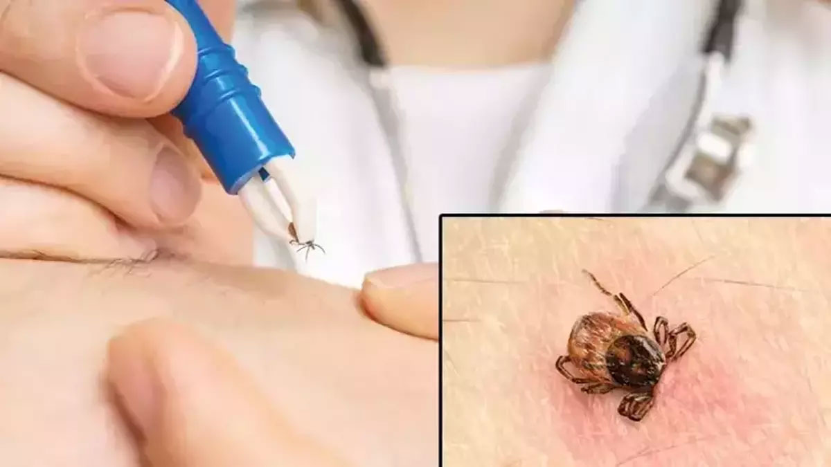 Kene krizi sürüyor! Tokat'ta 7 kişi KKKA hastalığı teşhisiyle tedavi görüyor