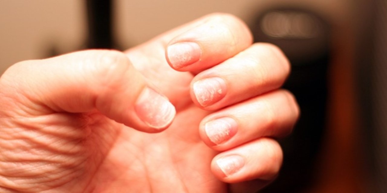 Tırnaklarda beliren çizgilere dikkat! Ölümcül hastalığın habercisi olabilir