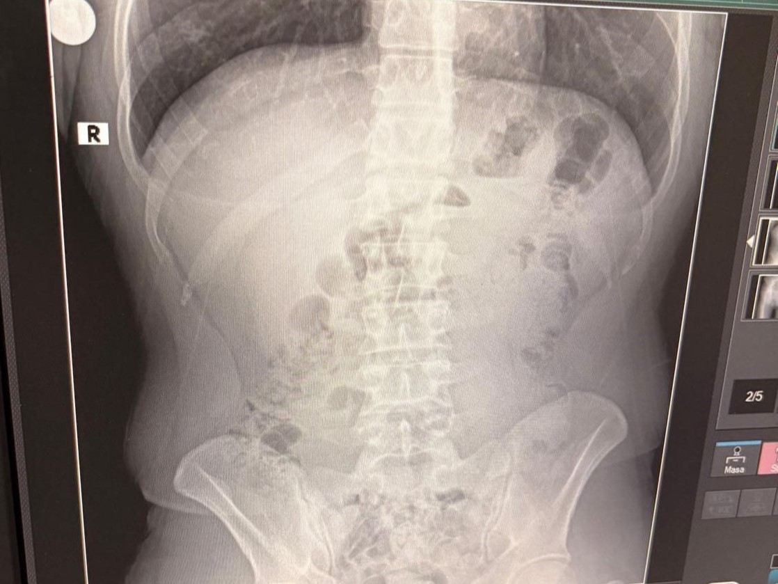 Uşak'ta 3 kişinin midelerinden uyuşturucu çıktı