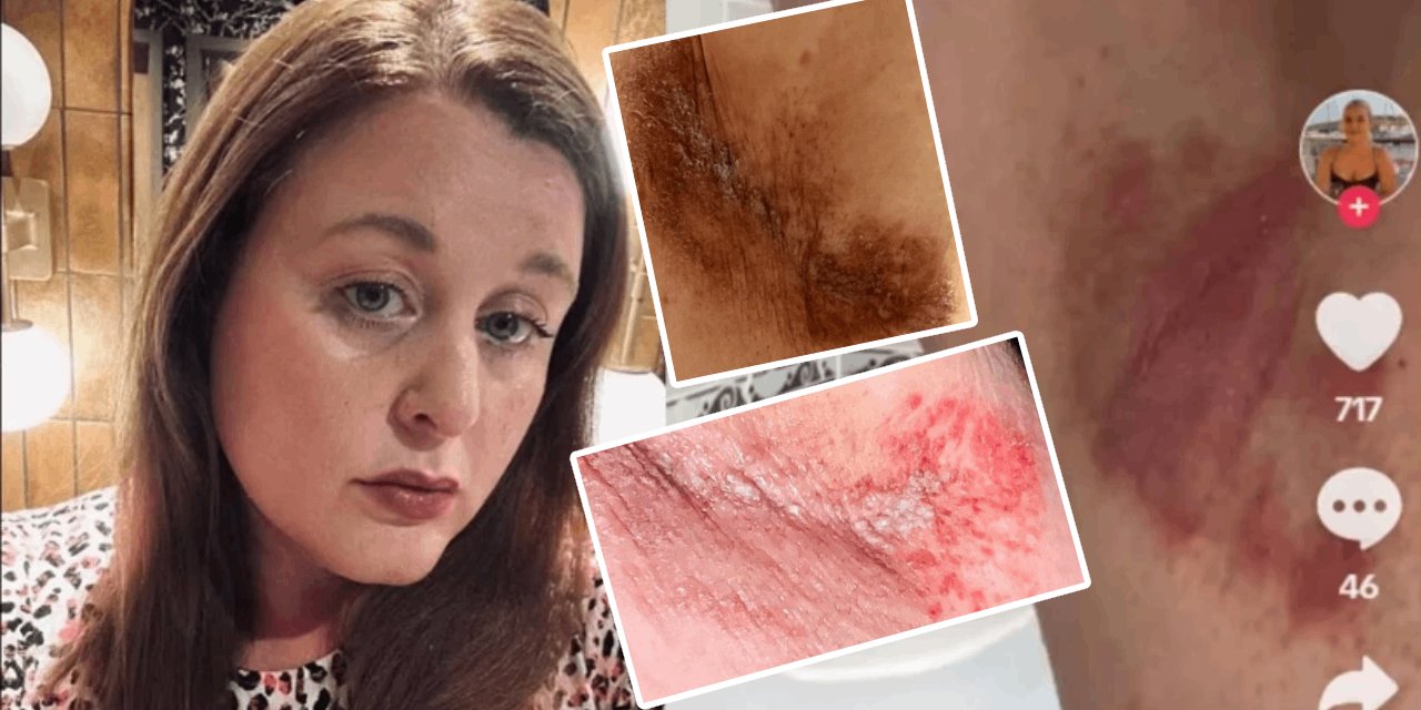 Ünlü kozmetik markasına ait kadın deodorantı ciddi yanıklara neden oldu