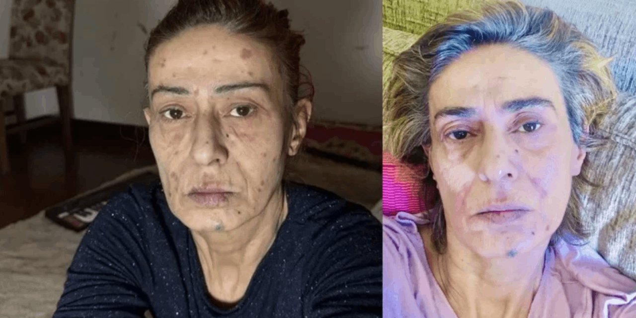 Yıldız Tilbe'nin yüzündeki yanık izleri dikkat çekti