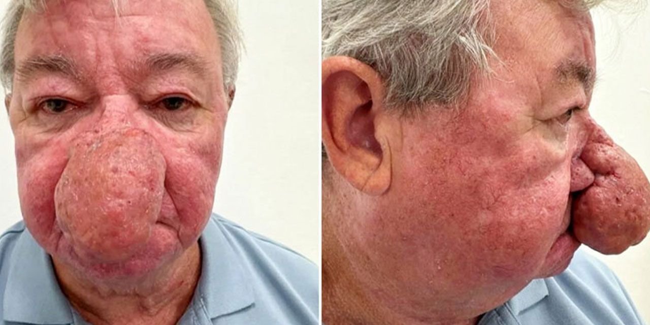 Burnu ağzını kapatacak kadar büyüdü: Hastalığı yıllar sonra ortaya çıktı