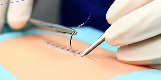 Doktor hastanın kafasında iğne unuttu! Büyük estetik skandalı