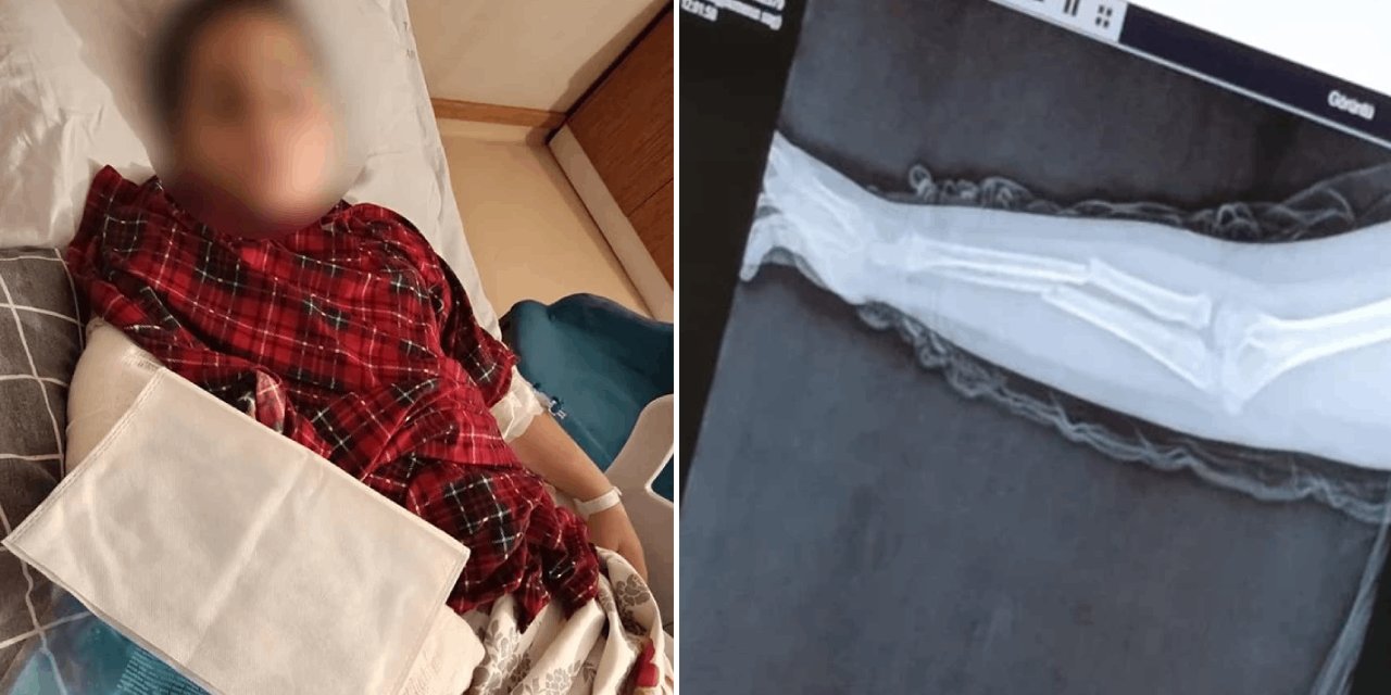 9 yaşındaki bir çocuk, 8 yaşındaki arkadaşının kolunu iki yerinden kırdı: Sebebini böyle açıkladı