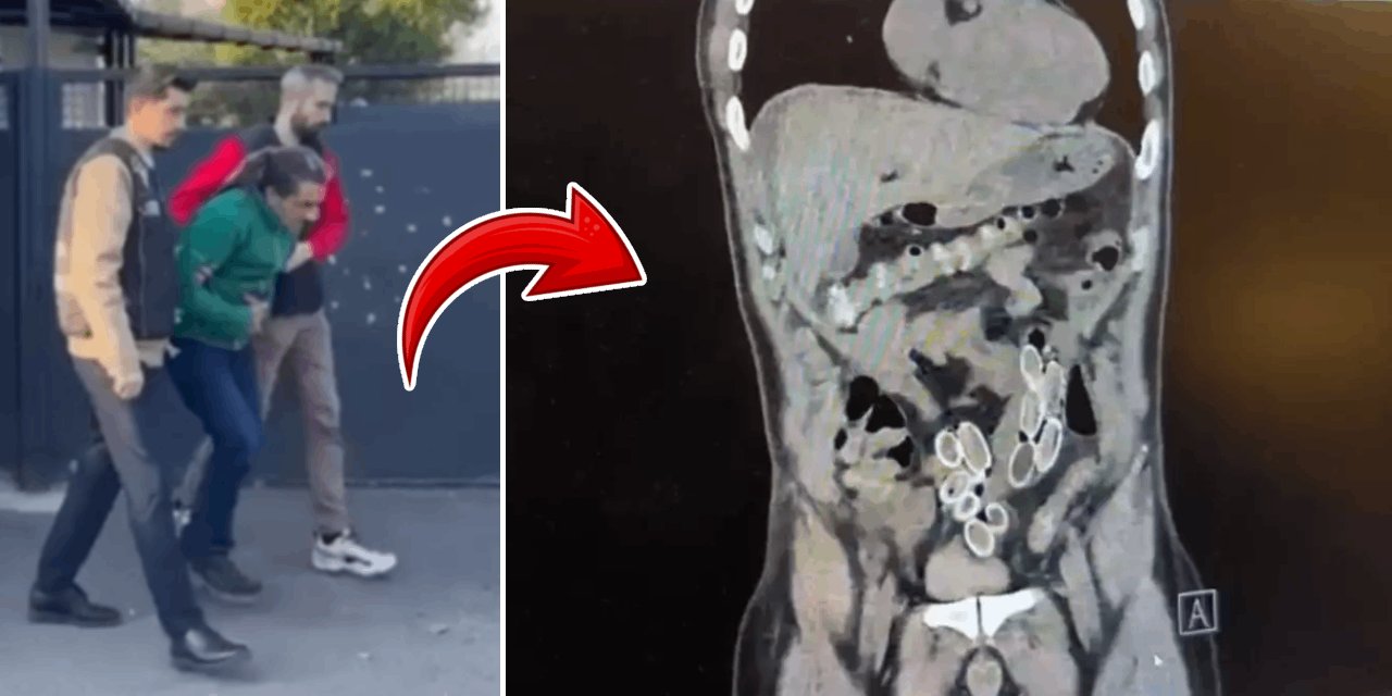 Mide ağrısıyla hastaneye gitti, gerçek ameliyatta ortaya çıktı: Fas'tan Türkiye'ye 49 tane taşımış