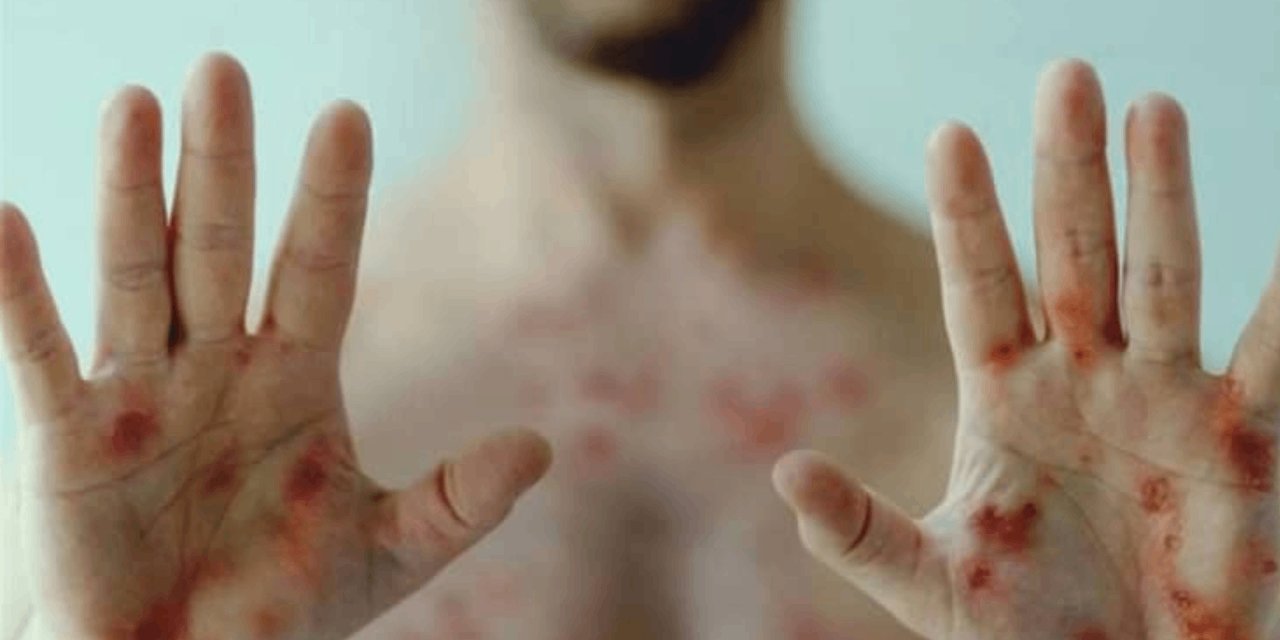 Gana'da M çiçeği alarmı: 1000’i aşkın vaka, 8 can kaybı