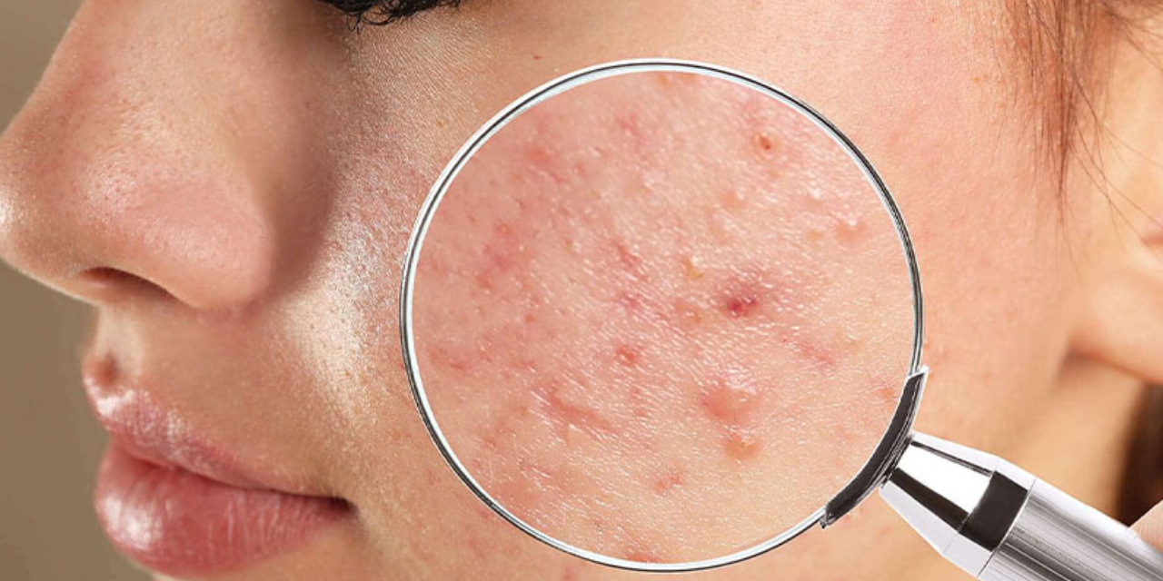 Gençlik sırrı sivilce mi? Araştırmalar dikkat çekici bir bağlantıya işaret ediyor