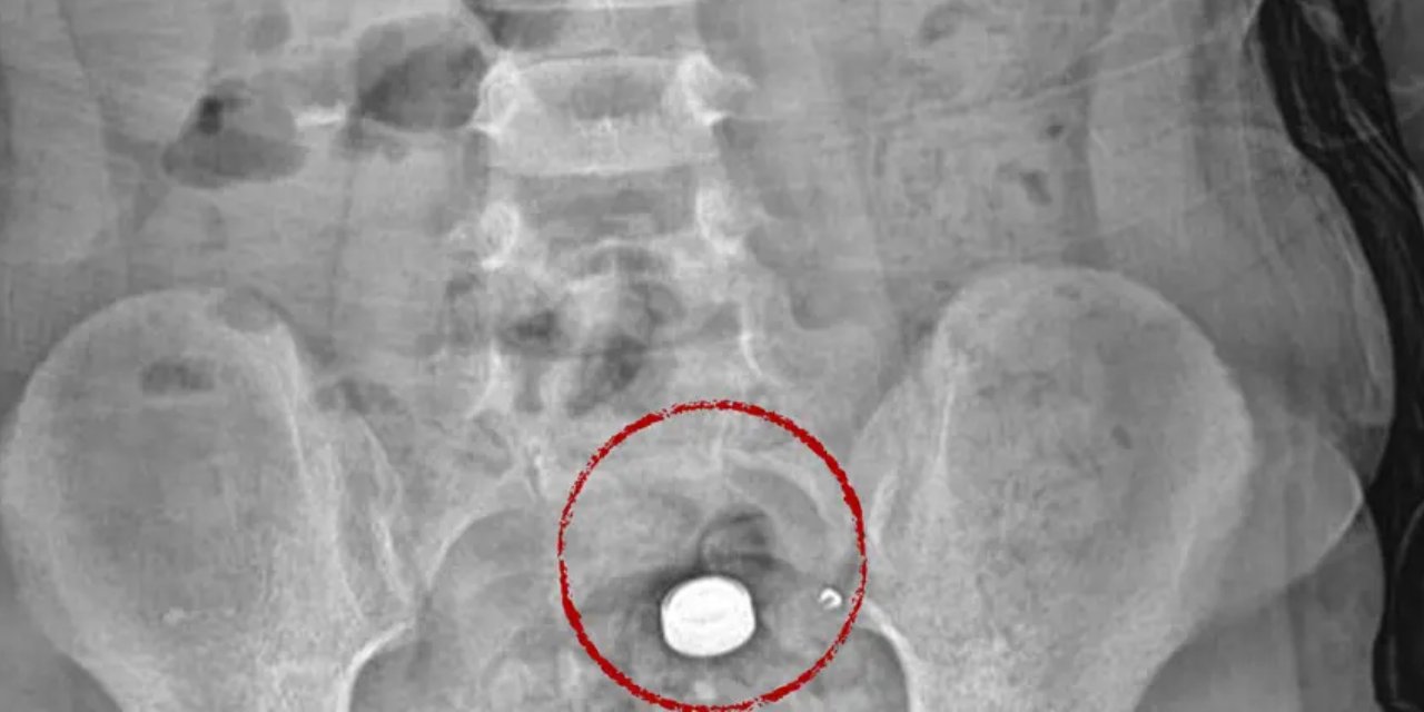 4 yaşındaki çocuk parkta bulduğu pili şeker sanıp yuttu: Doktorlardan "öldürebilir" açıklaması
