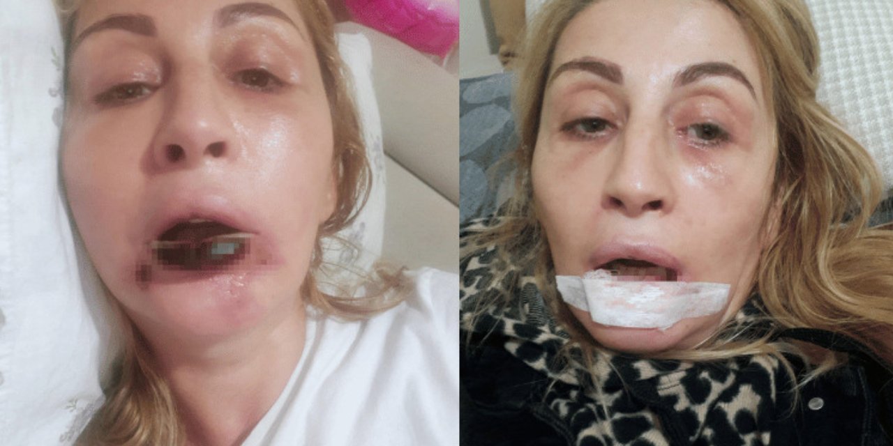 Göbek yağından yapılan dolgu dudağını koparttı: Estetik skandalında şok karar