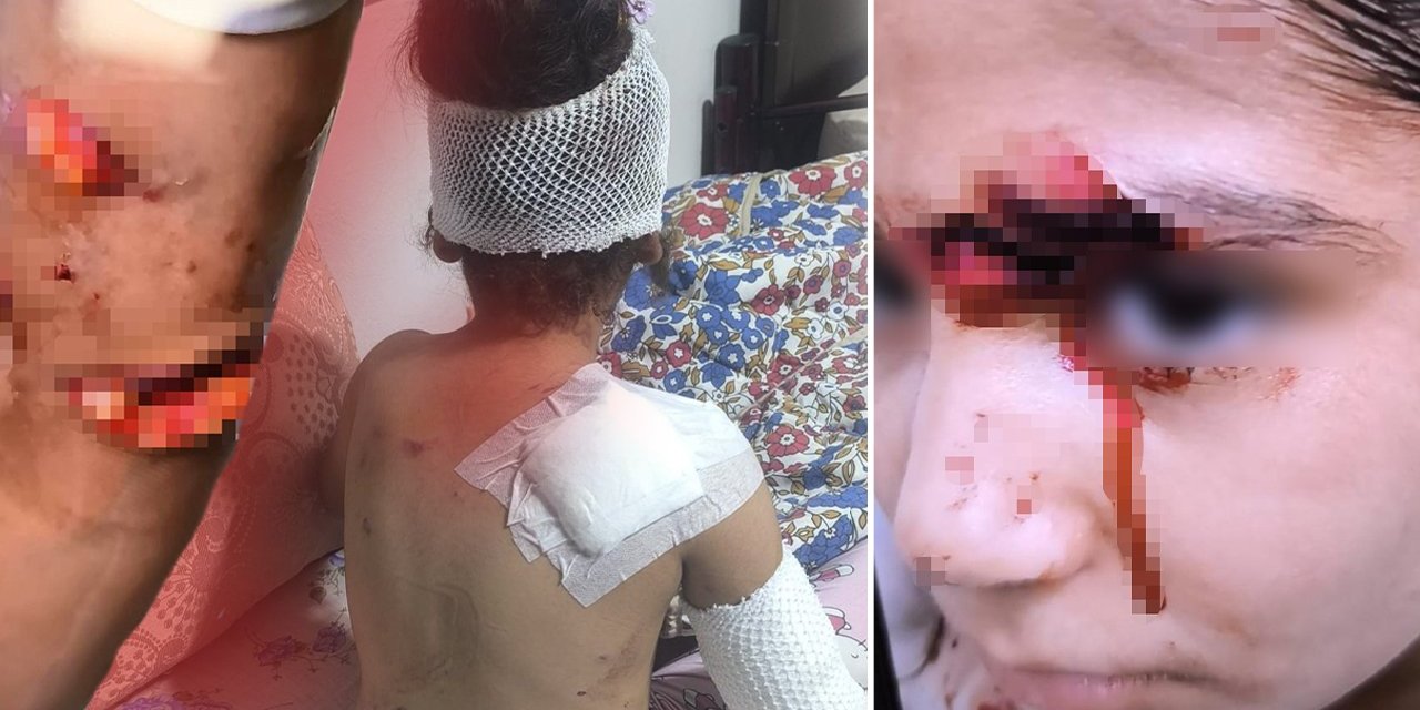Şanlıurfa'da dehşet: Küçük kıza 8 sokak köpeği saldırdı