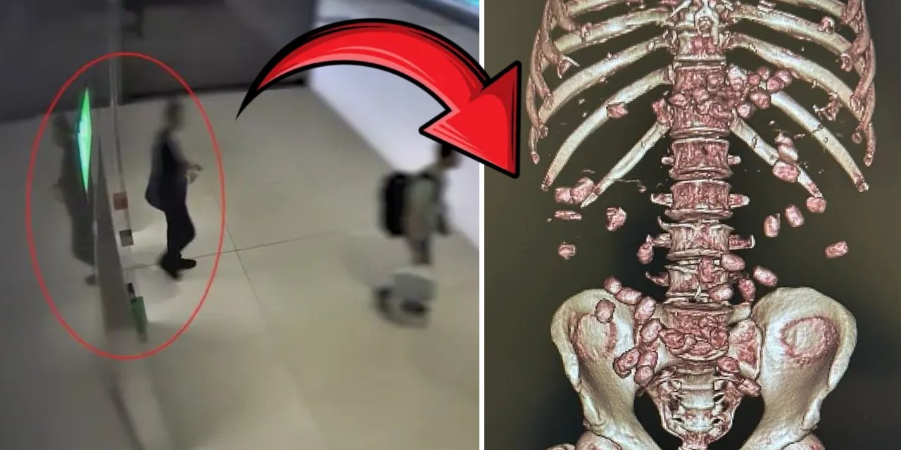 Yürümekte zorlanınca yakalandı! Midesinden çıkanlar şoke etti