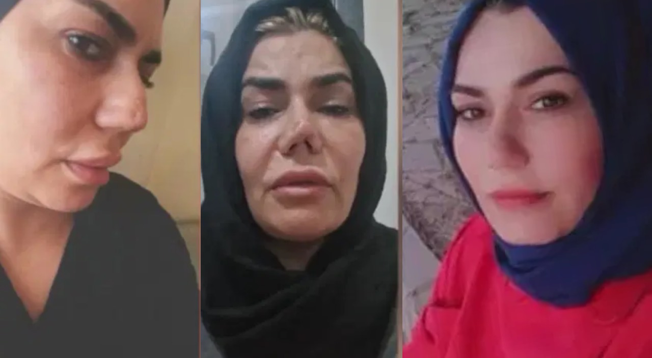 Estetik ameliyatında burnu bu hale geldi: Doktordan şikayetçi oldu