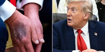 Donald Trump kayıp mı? Hastalığı son günlerde artmış vücudu morarmıştı
