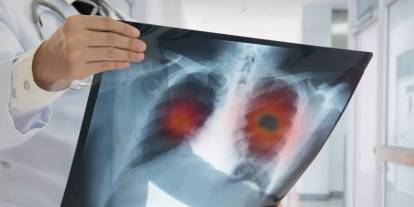 Akciğer kanseri için yeni tedavi yöntemi bulundu