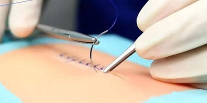 Doktor hastanın kafasında iğne unuttu! Büyük estetik skandalı