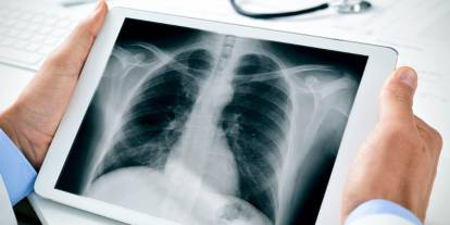 Türkiye’de akciğer kanseri vakaları artıyor: Bu iller daha yüksek risk altında