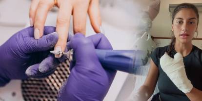 Manikür sonrası hastanelik oldu: 18 günde 6 ameliyat oldu 48 dikiş atıldı