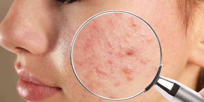 Gençlik sırrı sivilce mi? Araştırmalar dikkat çekici bir bağlantıya işaret ediyor