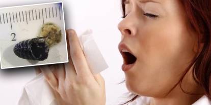 Bir hapşırık her şeyi değiştirdi: Burnundan çıkan larva bilim dünyasını şaşırttı