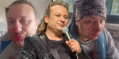 Köpeğin saldırısına uğrayan Onur Akay'dan kötü haber: Tekrar ameliyata alınacak