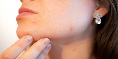 Diyet sivilceyi düzeltebilir mi? Dermatologlar sosyal medyadaki "temiz beslenme" akımı için ne diyor?