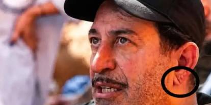 Frank işareti nedir? Cem Yılmaz'ın kalp krizi sonrası gündeme gelen belirti ne anlama geliyor?