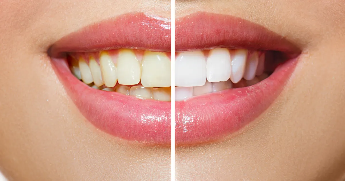 ollm-teeth-whitening-kit.webp