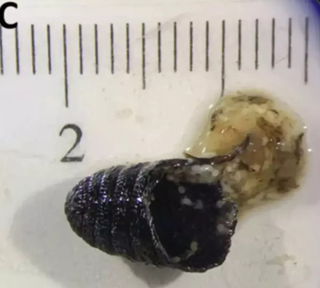 kadinin-burnundan-larva-cikti2.jpg