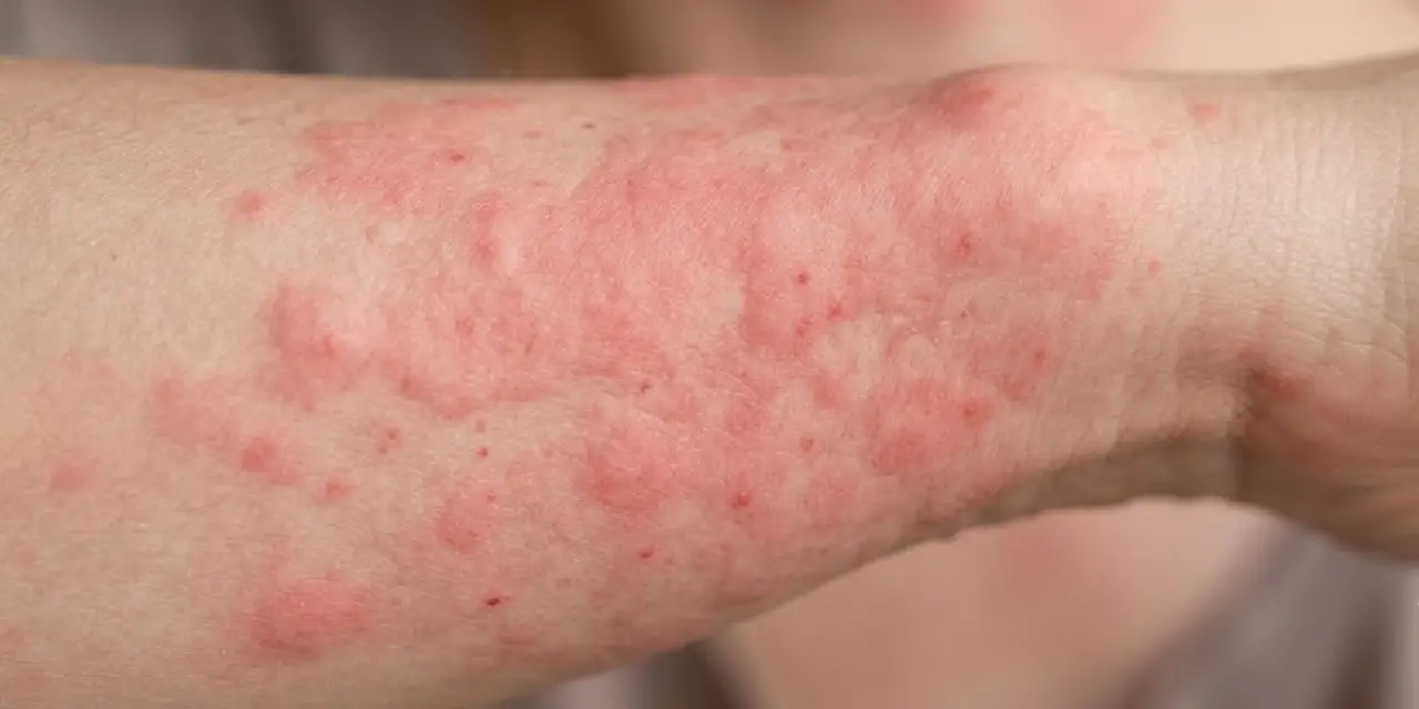 histamin-kizarikligi-nedir.webp
