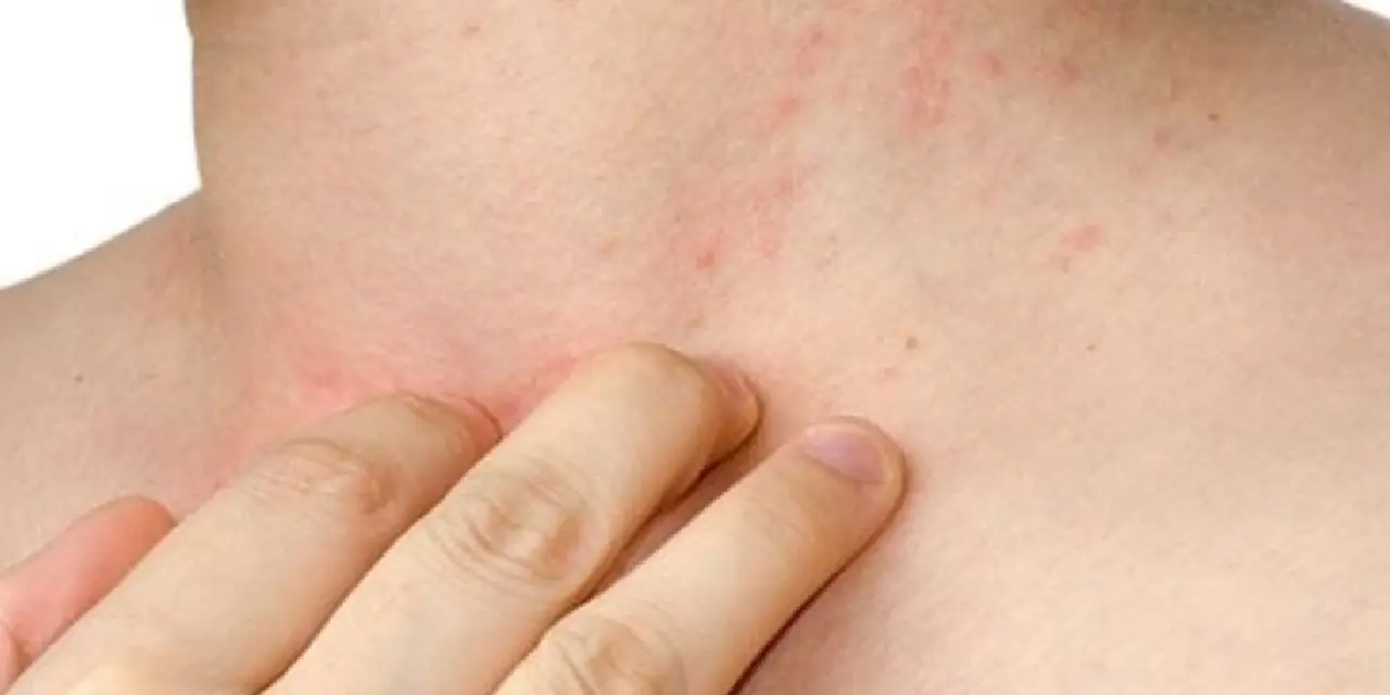 yuz-kizarmasi-histamin.webp